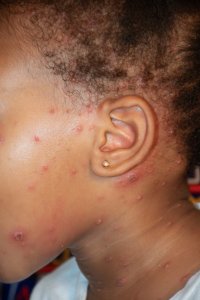 Rougeole sur un enfant's skin - Visible skin signs