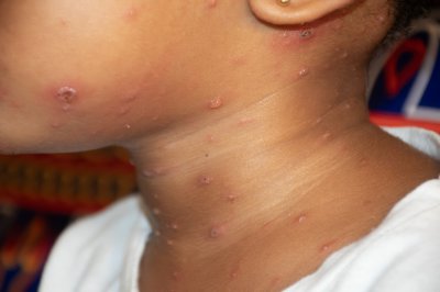 Rougeole éruption cutanée sur un enfant's neck et chin